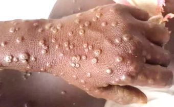 Mpox in Ghana: What you need to know about the re-emerging disease