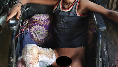 A Ray of Hope: Ujawal Jha's Humanitarian Mission to Save a Burn Victim's Life