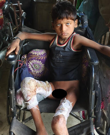 A Ray of Hope: Ujawal Jha's Humanitarian Mission to Save a Burn Victim's Life