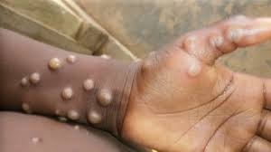Ghana Health Service confirms Mpox cases in Accra
