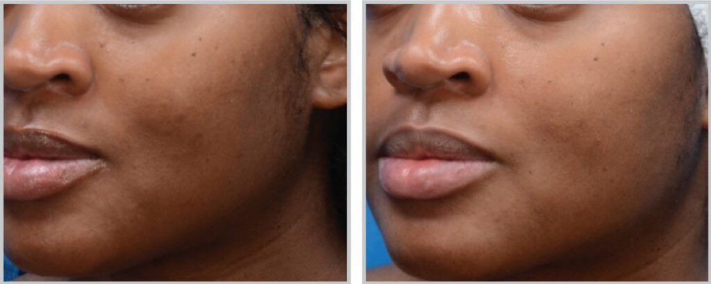 What is really the difference between bleaching and skin toning? Here's all you need know