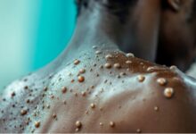 New Mpox cases hits, 14, no deaths or admissions reported