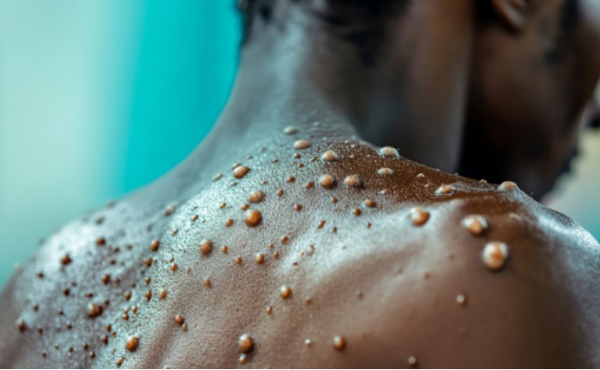 New Mpox cases hits, 14, no deaths or admissions reported