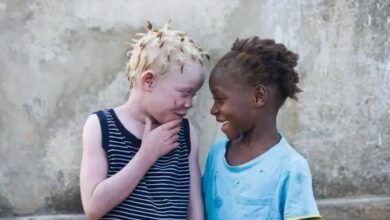 Persons with Albinism