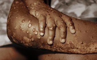 Ghana's Mpox Cases soar to 302 as GHS confirms 20 new infections