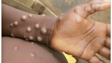 mpox ghana