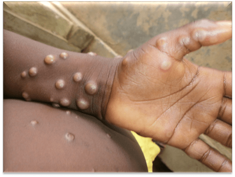mpox ghana