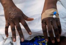 Ghana Health Service Issues Public Alert Following Marburg Virus Outbreak in Ethiopia