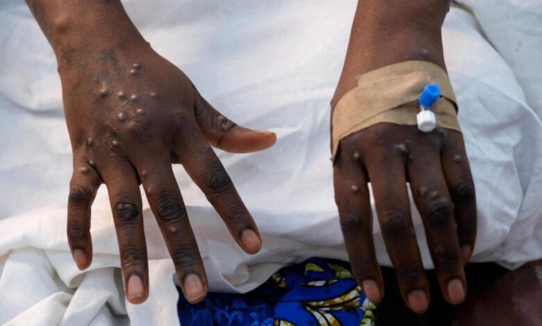 Ghana Health Service Issues Public Alert Following Marburg Virus Outbreak in Ethiopia